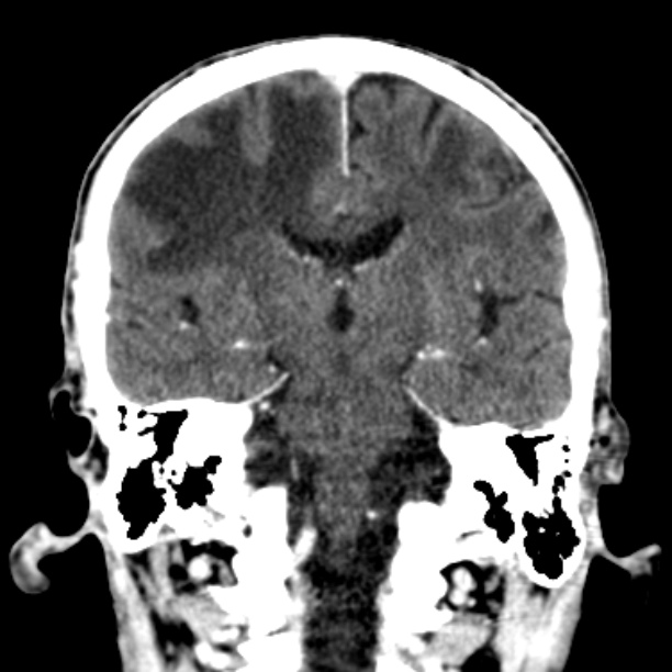 Brain metastases from lung cancer (Radiopaedia 27849-28092 Coronal C+ delayed 36).jpg