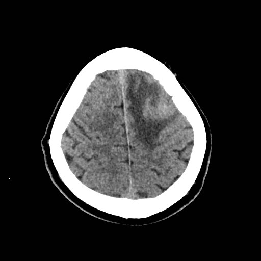 File:Brain metastases from lung cancer (Radiopaedia 83839-99027 Axial non-contrast 30).jpg