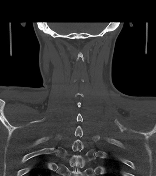 Branchial cleft cyst (Radiopaedia 31167-31875 Coronal bone window 52).jpg