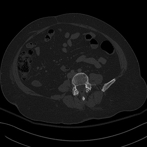File:Breast carcinoma with pathological hip fracture (Radiopaedia 60314-67993 Axial bone window 5).jpg