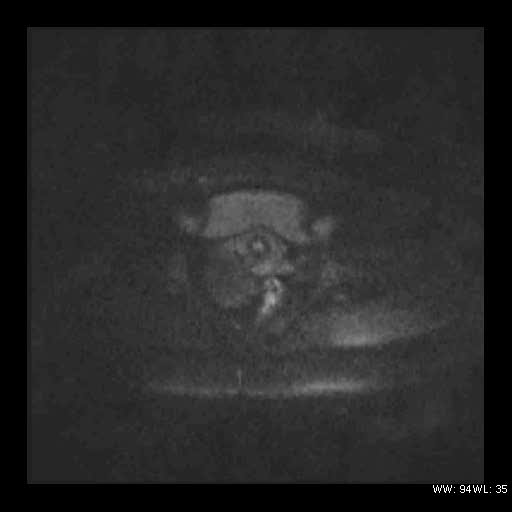 File:Broad ligament fibroid (Radiopaedia 49135-54241 Axial DWI 23).jpg