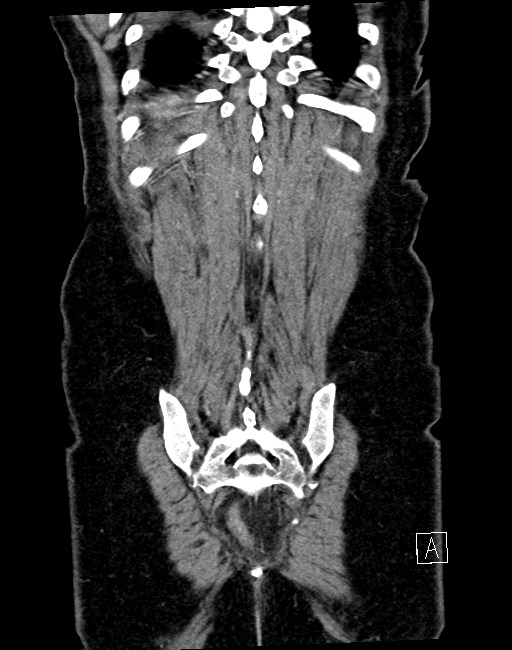 Broad ligament hernia (Radiopaedia 84802-100276 B 2).jpg