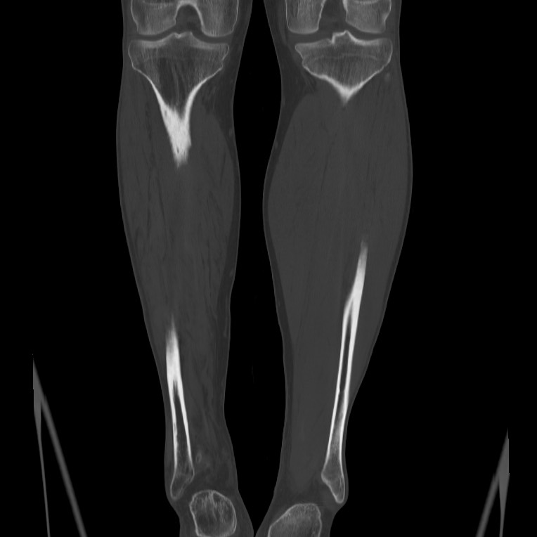 Brodie abscess - tibia (Radiopaedia 66028-75204 Coronal bone window 49).jpg