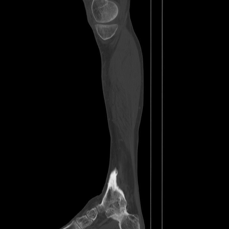 Brodie abscess - tibia (Radiopaedia 66028-75204 Sagittal bone window 3).jpg