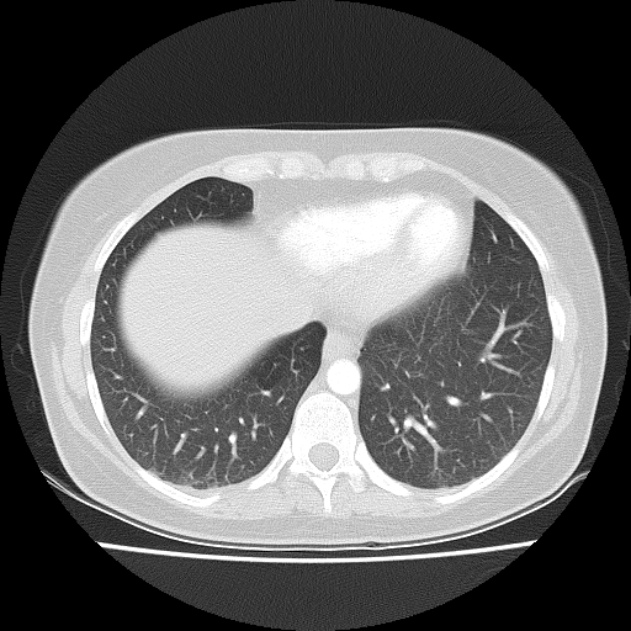 Bronchial atresia (Radiopaedia 22965-22992 Axial lung window 14).jpg