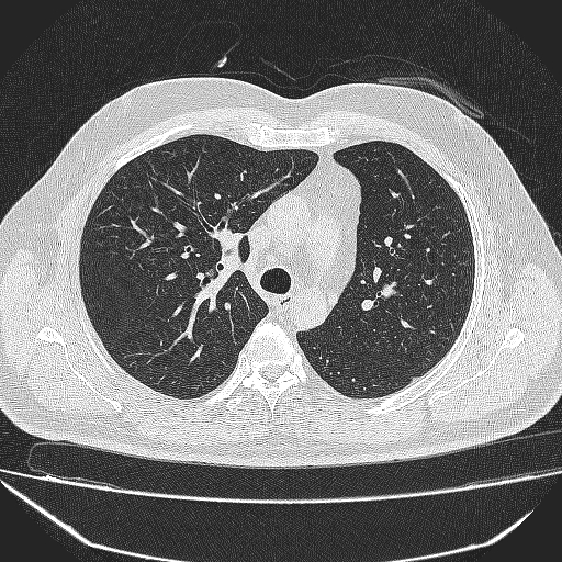 File:Bronchial atresia (Radiopaedia 58271-65417 Axial lung window 17).jpg