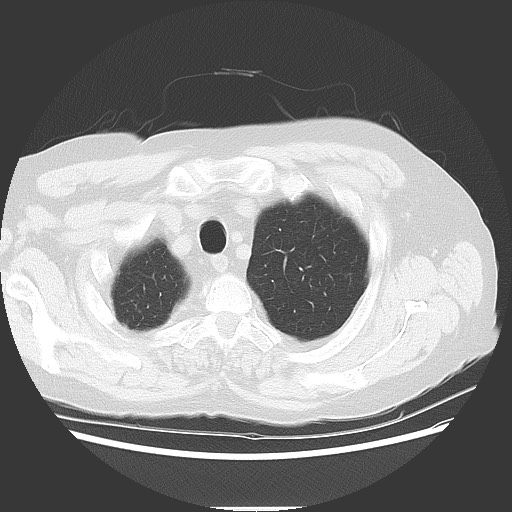 Bronchial stenosis - lung transplant (Radiopaedia 73133-83848 Axial lung window 11).jpg