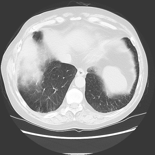 Bronchial stenosis - lung transplant (Radiopaedia 73133-83848 Axial lung window 49).jpg