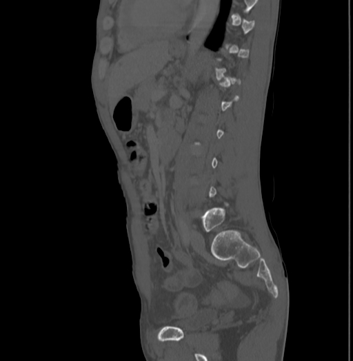 Bronchiectasis in Crohn disease (Radiopaedia 60311-67977 Sagittal bone window 155).jpg