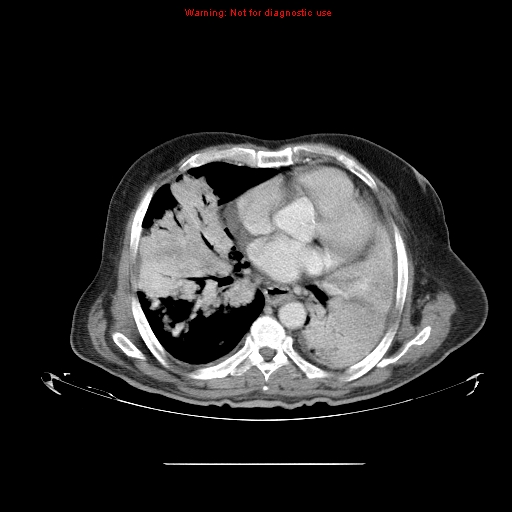 File:Bronchioloalveolar carcinoma (Radiopaedia 9272-9955 A 17).jpg