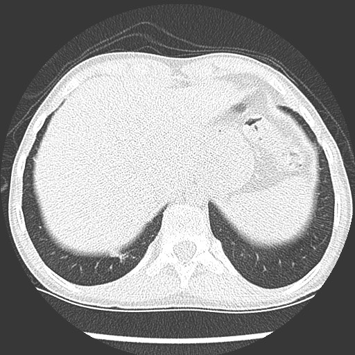 Bronchiolotis obliterans (Radiopaedia 73769-84575 Axial lung window 43).jpg