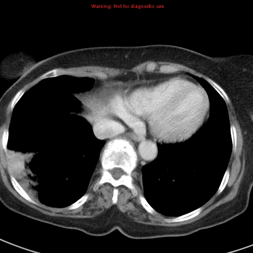 File:Bronchoalveolar carcinoma (BAC) (Radiopaedia 13436-13392 B 41).jpg