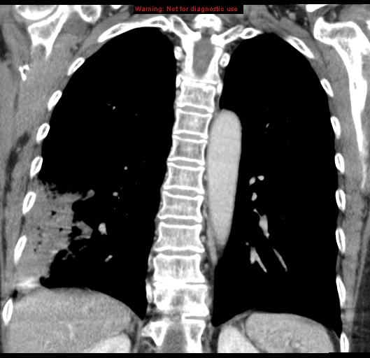 Bronchoalveolar carcinoma (BAC) (Radiopaedia 13436-13392 E 40).jpg