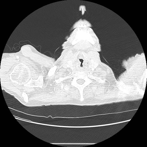 Bronchocele (Radiopaedia 17097-16795 Axial lung window 1).jpg