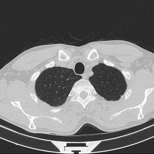 Bronchocele (Radiopaedia 60676-68429 Axial lung window 8).jpg