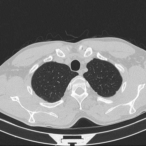 File:Bronchocele (Radiopaedia 60676-68429 Axial lung window 9).jpg