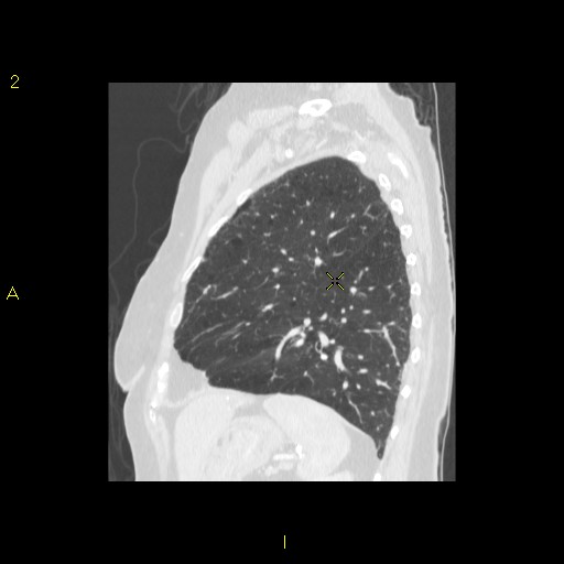 File:Bronchogenic carcinoma as an incidental finding (Radiopaedia 16453-16130 Sagittal lung window 15).jpg