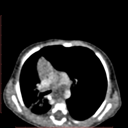 Bronchogenic cyst (Radiopaedia 78599-91409 B 91).jpg
