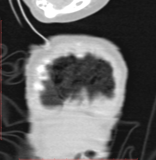Bronchogenic cyst (Radiopaedia 78599-91409 Coronal lung window 16).jpg