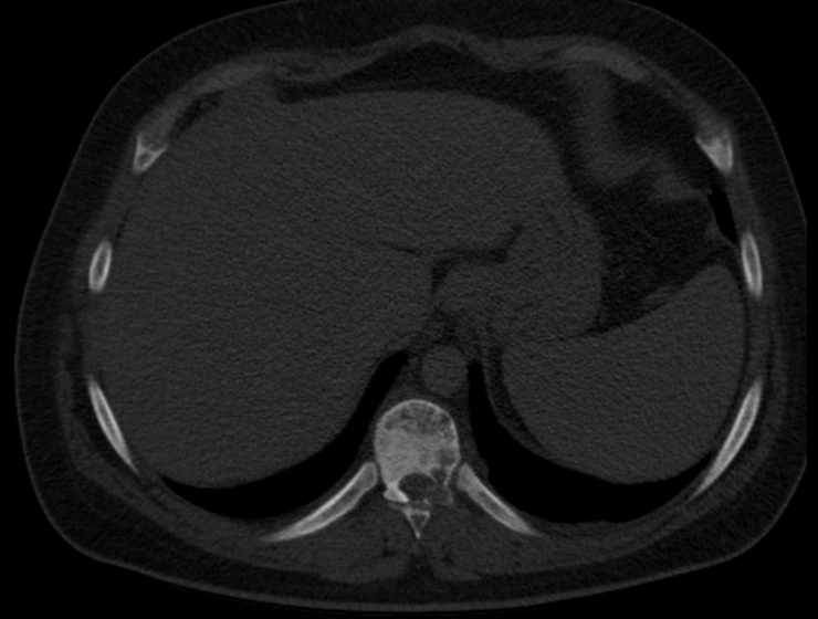 File:Brown tumors compressing the spinal cord (Radiopaedia 68442-77988 Axial bone window 65).jpg