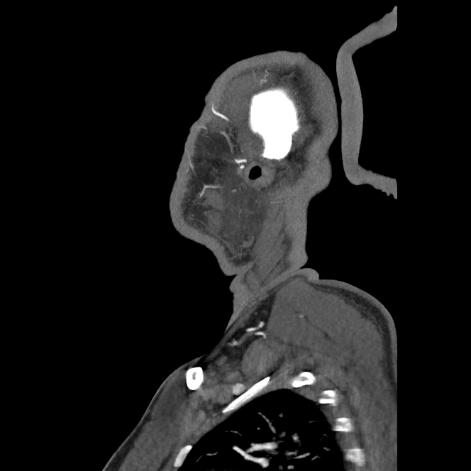Buccal fat pad arteriovenous malformation (Radiopaedia 70936-81144 C 23).jpg