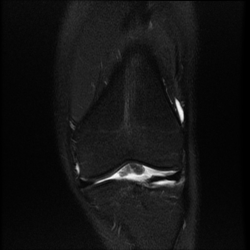 File:Bucket-handle meniscus tear (Radiopaedia 65700-74809 Coronal T2 fat sat 14).jpg