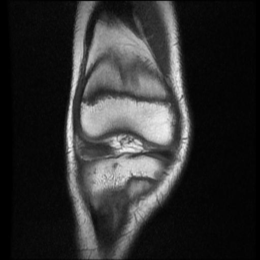 File:Bucket handle tear - lateral meniscus (Radiopaedia 72124-82634 Coronal T1 5).jpg