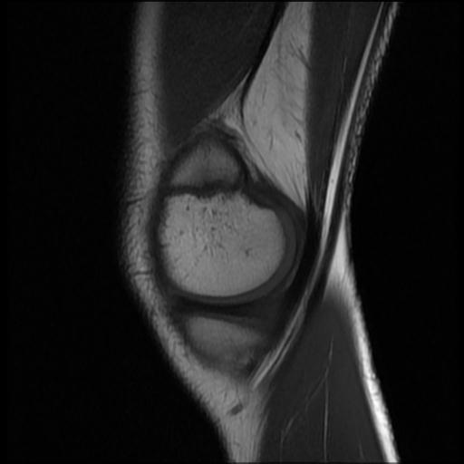 File:Bucket handle tear - lateral meniscus (Radiopaedia 72124-82634 Sagittal T1 14).jpg