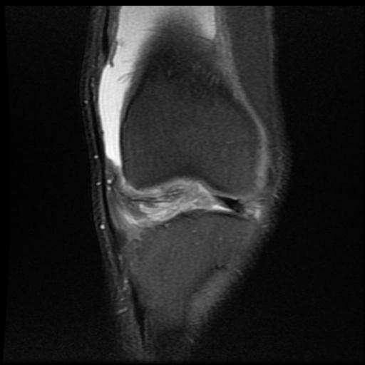 File:Bucket handle tear - medial meniscus (Radiopaedia 69245-79026 Coronal PD fat sat 6).jpg