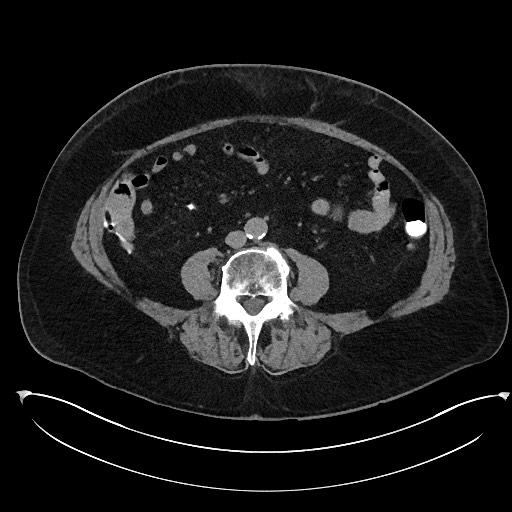 Buried bumper syndrome - gastrostomy tube (Radiopaedia 63843-72577 Axial Inject 70).jpg
