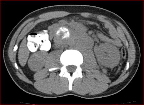 File:Burned-out testicular choriocarcinoma (Radiopaedia 32822-34040 Axial non-contrast 11).jpg
