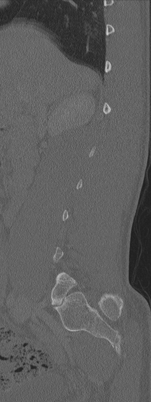 Burst fracture - T12 with conus compression (Radiopaedia 56825-63647 Sagittal bone window 66).png