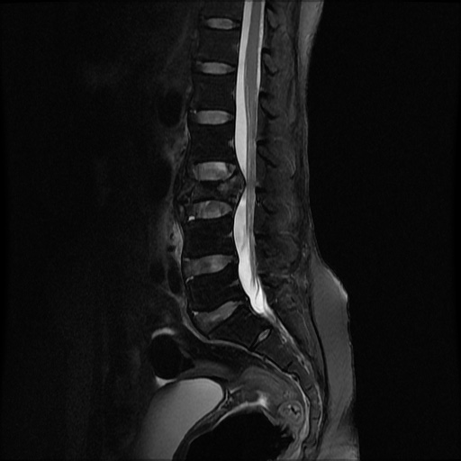 File:Burst fracture - lumbar spine (Radiopaedia 72877-83541 Sagittal STIR 5).jpg