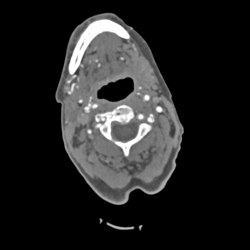 C2 fracture with vertebral artery dissection (Radiopaedia 37378-39200 A 158).png