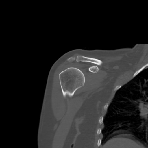 File:Calcific tendinitis of the infraspinatus tendon (Radiopaedia 87256-103539 Coronal bone window 22).jpg