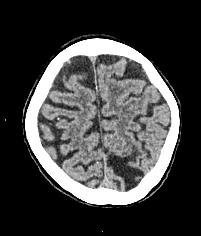 Calcified cerebral emboli from left ventricular thrombus (Radiopaedia 84420-99758 Axial non-contrast 22).jpg