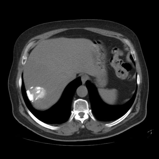 File:Calcified hepatic hydatid cyst (Radiopaedia 18907-18853 Axial non-contrast 7).jpg