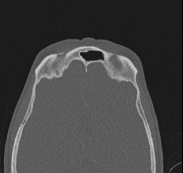 Caldwell-Luc operation (Radiopaedia 52329-58225 Axial bone window 13).jpg