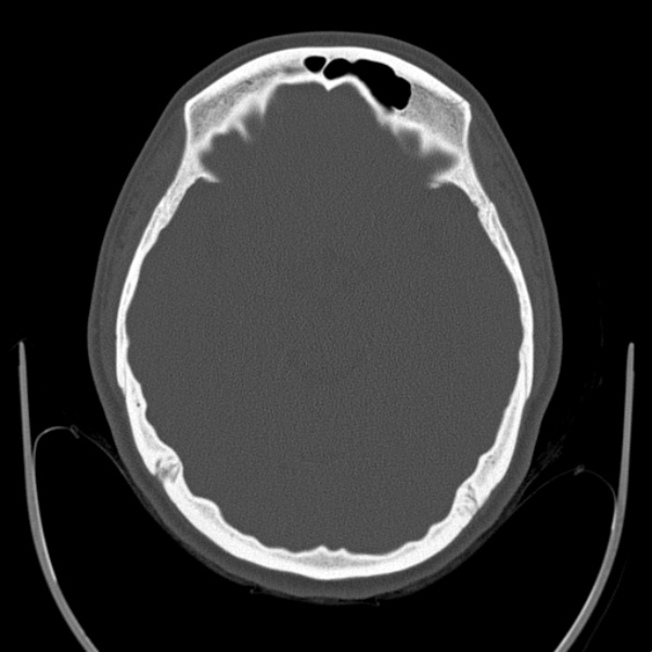 Calvarial osteoma (Radiopaedia 36520-38079 Axial bone window 43).jpg