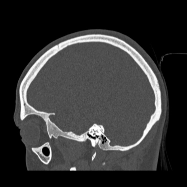 Calvarial osteoma (Radiopaedia 36520-38079 Sagittal bone window 78).jpg
