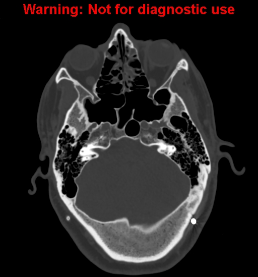 Calvarial thickening from chronic shunting (Radiopaedia 60079-67637 Axial bone window 45).jpg