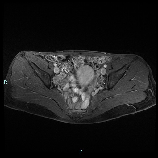File:Canal of Nuck cyst (Radiopaedia 55074-61448 Axial T1 C+ fat sat 26).jpg