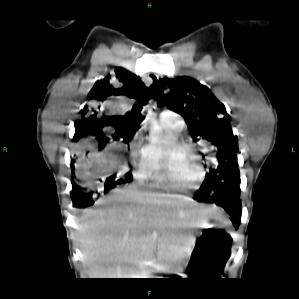 File:Cannon ball metastases - synovial sarcoma (Radiopaedia 26135-26271 Coronal liver window 2).jpg