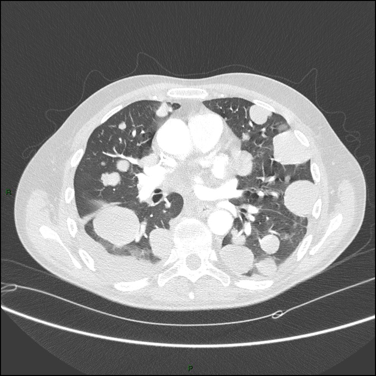 Cannonball metastases (Radiopaedia 82110-96150 Axial lung window 103).jpg
