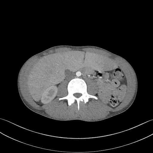 Cannonball metastases - testicular choriocarcinoma (Radiopaedia 84510-99891 B 134).jpg