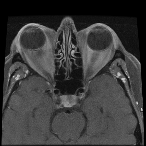 File:Carcinoid tumor of the ileum with metastasis to orbit (Radiopaedia 28165-28424 Axial T1 C+ fat sat 8).jpg