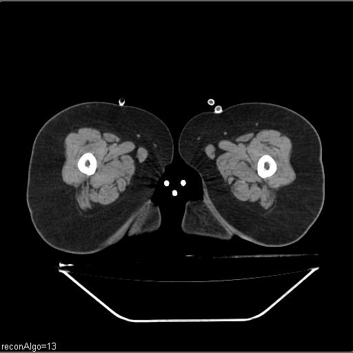 File:Carcinoma cervix- brachytherapy applicator (Radiopaedia 33135-34173 Axial non-contrast 75).jpg