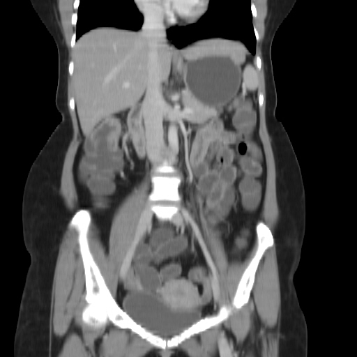 File:Carcinoma colon - hepatic flexure (Radiopaedia 19461-19493 B 20).jpg