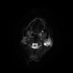 File:Carcinoma ex-pleomorphic adenoma of parotid (Radiopaedia 28383-28627 Ax DWI B-500 GE 13).jpg