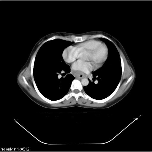 File:Carcinoma of esophagus (Radiopaedia 27356-27550 A 16).jpg
